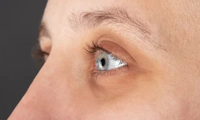 La chirurgie du kératocône : une solution lumineuse pour une maladie obscure